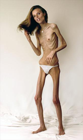 Anoreksja chude baby - Anoreksja491.jpg